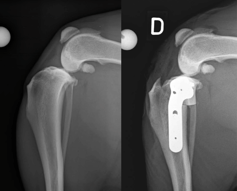 Radiographies du genou droit d’un Labrador Retriever souffrant d’une rupture partielle du ligament croisé antérieur : gauche avant l’intervention et droite après TPLO